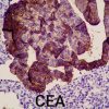 Adenocarcinoma de cérvix relacionado ao HPV (tipo usual)