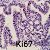 Adenocarcinoma de cérvix relacionado ao HPV (tipo usual)