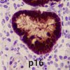 Adenocarcinoma de cérvix relacionado ao HPV (tipo usual)